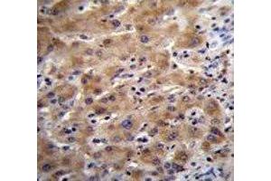 Glypican 3 antibody immunohistochemistry analysis in formalin fixed and paraffin embedded human liver tissue. (Glypican 3 anticorps  (AA 21-50))