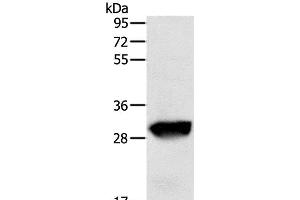 Western Blot analysis of Human liver cancer tissue using GSTO1 Polyclonal Antibody at dilution of 1:200 (GSTO1 anticorps)