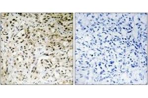 Immunohistochemistry analysis of paraffin-embedded human liver carcinoma tissue, using TAF5 Antibody. (TAF5 anticorps  (AA 381-430))