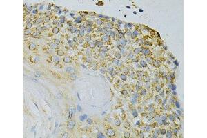 Immunohistochemistry of paraffin-embedded Human esophageal cancer using GPX4 Polyclonal Antibody at dilution of 1:200 (40x lens).