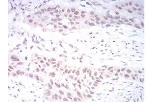Immunohistochemical analysis of paraffin-embedded esophageal cancer tissues using DNMT3B mouse mAb with DAB staining.