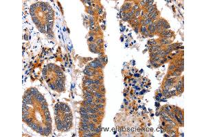 Immunohistochemistry of Human colon cancer using NCK1 Polyclonal Antibody at dilution of 1:30 (NCK1 anticorps)
