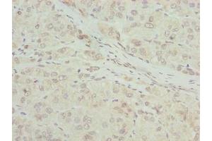 Immunohistochemistry of paraffin-embedded human liver cancer using ABIN7168087 at dilution of 1:100