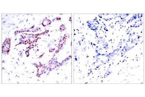 Immunohistochemical analysis of paraffin-embedded human breast carcinoma tissue using STAT1 (phospho-Tyr701) antibody (E011044). (STAT1 anticorps  (pTyr701))