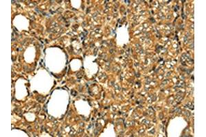 The image on the left is immunohistochemistry of paraffin-embedded Human thyroid cancer tissue using ABIN7130886(RLN1 Antibody) at dilution 1/20, on the right is treated with fusion protein. (Relaxin 1 anticorps)