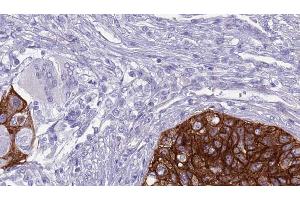 ABIN6268911 at 1/100 staining Human urothelial cancer tissue by IHC-P.
