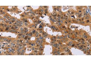 Immunohistochemistry of paraffin-embedded Human gasrtic cancer tissue using NIF3L1 Polyclonal Antibody at dilution 1:30 (NIF3L1 anticorps)
