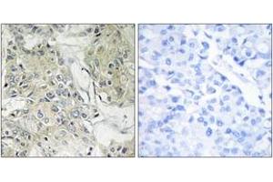 Immunohistochemistry analysis of paraffin-embedded human breast carcinoma tissue, using TM16J Antibody. (ANO9 anticorps  (AA 481-530))