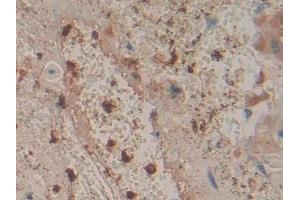 Detection of CORO1A in Human Lung cancer Tissue using Polyclonal Antibody to Coronin 1A (CORO1A)