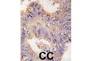Formalin-fixed and paraffin-embedded human colon carcinoma tissue reacted with TRAF2 polyclonal antibody  , which was peroxidase-conjugated to the secondary antibody, followed by DAB staining. (TRAF2 anticorps  (C-Term))