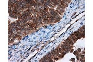 Immunohistochemical staining of paraffin-embedded Adenocarcinoma of breast tissue using anti-TPMT mouse monoclonal antibody. (TPMT anticorps)