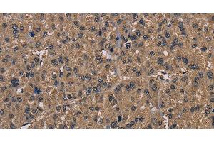 Immunohistochemistry of paraffin-embedded Human liver cancer tissue using FGF7 Polyclonal Antibody at dilution of 1:30 (FGF7 anticorps)