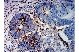 Immunohistochemical analysis of paraffin-embedded rectum cancer tissues using MUC16 mouse mAb with DAB staining. (MUC16 anticorps  (AA 1-200))