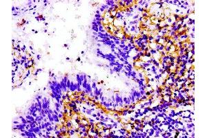 IHC image of ABIN7172220 diluted at 1:100 and staining in paraffin-embedded human lung cancer performed on a Leica BondTM system. (Titin anticorps  (AA 5398-5604))