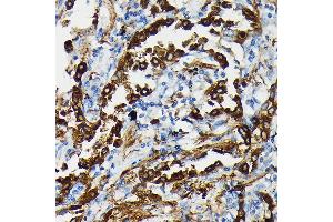 Immunohistochemistry of paraffin-embedded human lung cancer using SFTP Rabbit pAb (ABIN3017436, ABIN3017437, ABIN3017438 and ABIN6220091) at dilution of 1:50 (40x lens). (Surfactant Protein A1 anticorps)