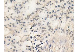 ABIN6259095 and ABIN6274375 at 1/100 staining human Hodgkin lymphoma by IHC-P.