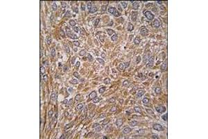 Formalin-fixed and paraffin-embedded human lung carcinoma tissue reacted with GIT1 Antibody (Y510), which was peroxidase-conjugated to the secondary antibody, followed by DAB staining.