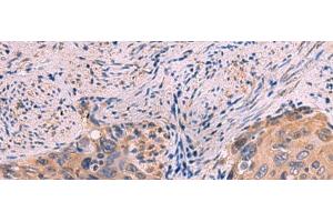 Immunohistochemistry of paraffin-embedded Human cervical cancer tissue using PPEF1 Polyclonal Antibody at dilution of 1:100(x200) (PPEF1 anticorps)