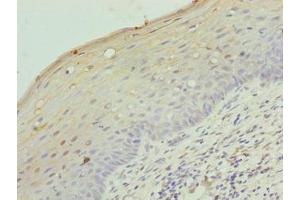 Immunohistochemistry of paraffin-embedded human cervical cancer using ABIN7158142 at dilution of 1:100