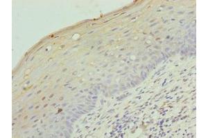 Immunohistochemistry of paraffin-embedded human cervical cancer using ABIN7158142 at dilution of 1:100 (LRRC18 anticorps  (AA 1-261))