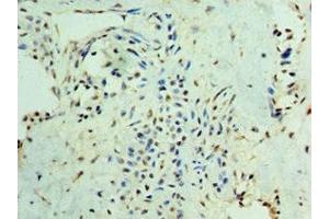 Immunohistochemistry of paraffin-embedded human breast cancer using ABIN7160232 at dilution of 1:100