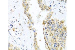 Immunohistochemistry of paraffin-embedded Human lung cancer using DARS2 Polyclonal Antibody at dilution of 1:100 (40x lens). (DARS2 anticorps)