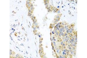 Immunohistochemistry of paraffin-embedded Human lung cancer using DARS2 Polyclonal Antibody at dilution of 1:100 (40x lens).