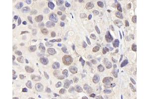 Immunohistochemistry analysis of paraffin-embedded Mouse breast cancer using CDC25A Polyclonal Antibody at dilution of 1:1000. (CDC25A anticorps)