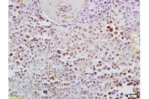 Formalin-fixed and paraffin embedded mouse lymphoma labeled with Anti-Phospho-NFKB p65(Ser276) Polyclonal Antibody, Unconjugated (ABIN700555) at 1:200, followed by conjugation to the secondary antibody and DAB staining (NF-kB p65 anticorps  (pSer276))