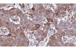 ABIN6276655 at 1/100 staining Human liver cancer tissue by IHC-P. (HFE anticorps  (Internal Region))