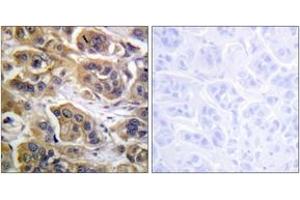 Immunohistochemistry analysis of paraffin-embedded human breast carcinoma tissue, using HER3 (Ab-1289) Antibody. (ERBB3 anticorps  (AA 1256-1305))