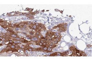 ABIN6277437 at 1/100 staining Human Head and neck cancer tissue by IHC-P. (TRAF7 anticorps  (N-Term))