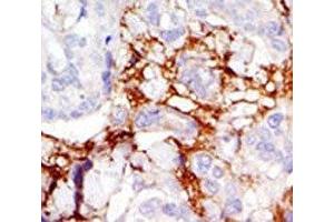 IHC analysis of FFPE human breast carcinoma tissue stained with the PAK3 antibody