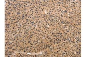 The image on the left is immunohistochemistry of paraffin-embedded Human liver cancer tissue using ABIN7189683(ADIPOR2 Antibody) at dilution 1/15, on the right is treated with synthetic peptide. (Adiponectin Receptor 2 anticorps)
