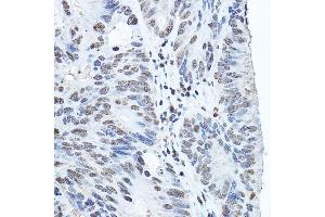 Immunohistochemistry of paraffin-embedded human colon carcinoma using Twist Rabbit pAb (ABIN6133951, ABIN6149713, ABIN6149716 and ABIN6220170) at dilution of 1:200 (40x lens).