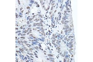 Immunohistochemistry of paraffin-embedded human colon carcinoma using Twist Rabbit pAb (ABIN6133951, ABIN6149713, ABIN6149716 and ABIN6220170) at dilution of 1:200 (40x lens). (TWIST1 anticorps  (AA 1-100))