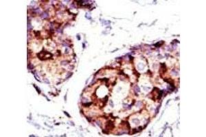 IHC analysis of FFPE human breast carcinoma tissue stained with the TSG101 antibody.