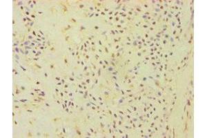 Immunohistochemistry of paraffin-embedded human breast cancer using ABIN7144871 at dilution of 1:100