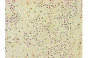 Immunohistochemistry of paraffin-embedded human breast cancer using ABIN7144871 at dilution of 1:100 (ATP5J anticorps  (AA 1-108))
