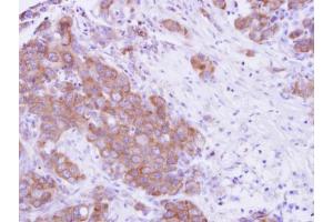 IHC-P Image MPP3 antibody detects MPP3 protein at cytosol on human breast cancer by immunohistochemical analysis. (MPP3 anticorps  (Center))