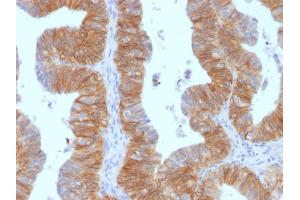 Formalin-fixed, paraffin-embedded human Ovarian Carcinoma stained with EpCAM Mouse Monoclonal Antibody (EGP40/1384). (EpCAM anticorps  (Extracellular Domain))