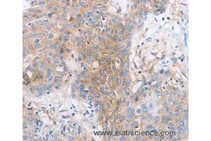 Immunohistochemistry of Human cervical cancer using LILRB2 Polyclonal Antibody at dilution of 1:30 (LILRB2 anticorps)
