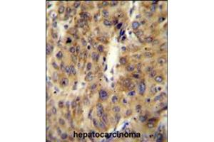ACF Antibody immunohistochemistry analysis in formalin fixed and paraffin embedded human hepatocarcinoma followed by peroxidase conjugation of the secondary antibody and DAB staining. (A1CF anticorps  (C-Term))