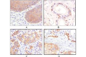 Immunohistochemical analysis of paraffin-embedded human esophagus epithelium (A), salivary gland basal cell (B), lung squamous cell carcinoma (C), endometrium admosquamous carcinoma (D), showing cytoplasmic and membrane localization using CK5 mouse mAb with DAB staining. (Cytokeratin 5 anticorps)