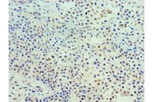 Immunohistochemistry of paraffin-embedded human breast cancer using ABIN7172113 at dilution of 1:100