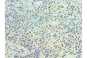 Immunohistochemistry of paraffin-embedded human breast cancer using ABIN7172113 at dilution of 1:100 (TK1 anticorps  (AA 1-234))