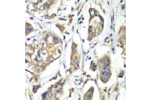 Immunohistochemistry of paraffin-embedded human liver cancer using NFS1 antibody (ABIN6291967) at dilution of 1:100 (40x lens). (NFS1 anticorps)