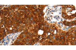 Immunohistochemistry of paraffin-embedded Human lung cancer using VWA5A Polyclonal Antibody at dilution of 1:60 (VWA5A anticorps)