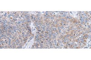 Immunohistochemistry of paraffin-embedded Human liver cancer tissue using ENPP2 Polyclonal Antibody at dilution of 1:50(x200) (ENPP2 anticorps)
