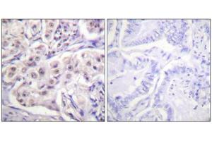 Immunohistochemistry analysis of paraffin-embedded human lung carcinoma tissue using hnRPD (epitope around residue 83) antibody.